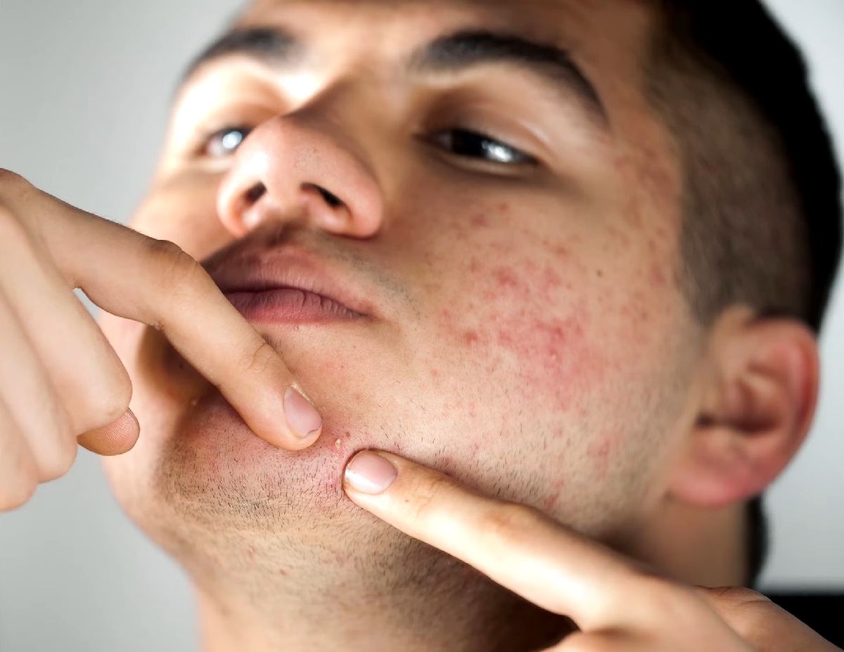 A young man with acne pressing his fingers on his chin, highlighting the importance of avoiding facial contact