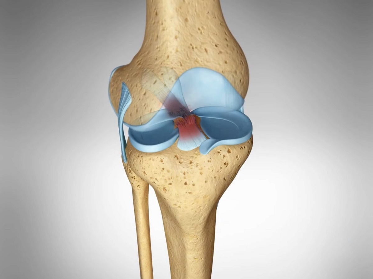 Illustration of an anterior cruciate ligament (ACL) tear in the knee