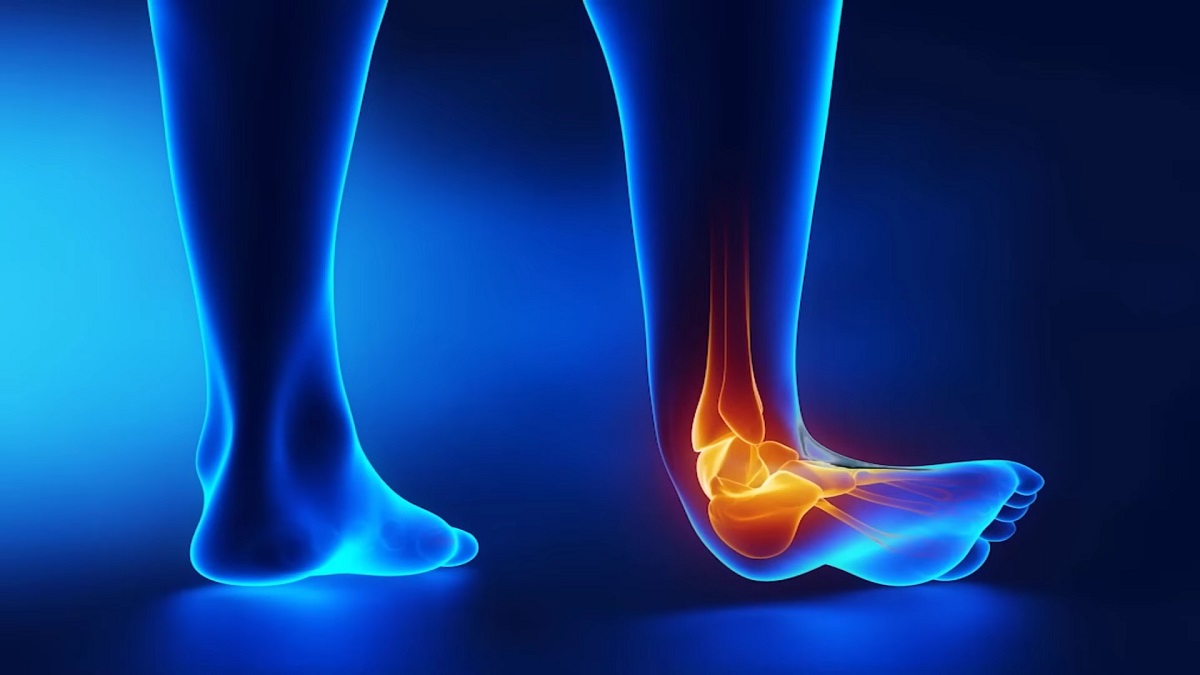 A digital medical illustration depicting an ankle sprain