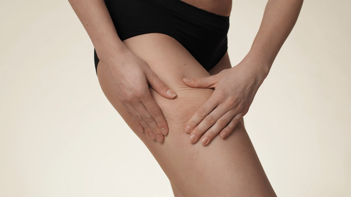 A girl is pointing with her hand to a spot on her thigh where cellulite most commonly appears