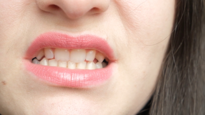 A close-up of a woman clenching her teeth, highlighting the strain and tension linked to teeth grinding