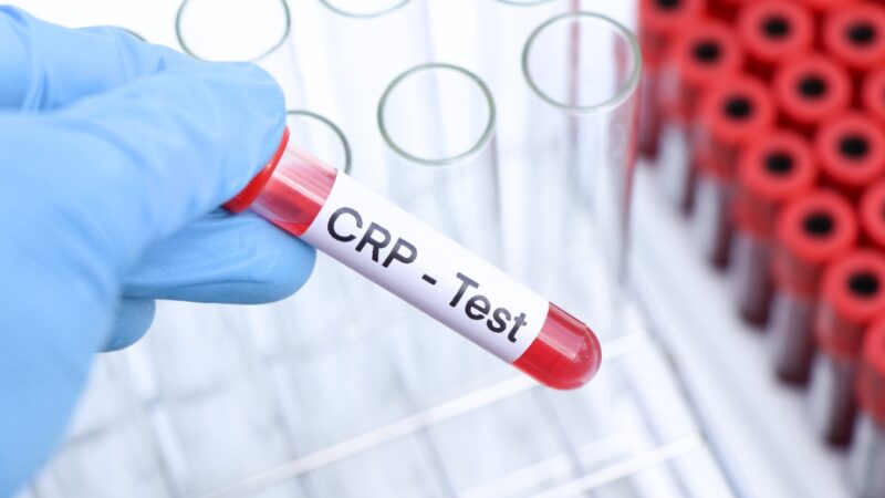 Gloved hand holds a CRP blood test sample in a lab
